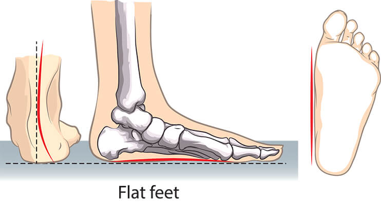 Best Foot Braces for Flat Feet - Complete Reviews In 2020